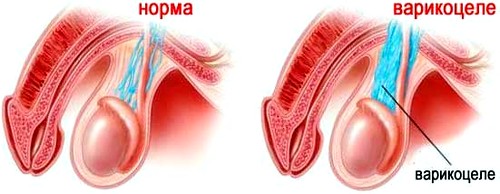Фото Варикоцеле: как лечить мужское бесплодие из раздела Исследование / unlinked