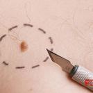 Фото Как лечат меланому? из раздела Исследование /