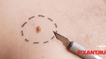 Фото Как лечат меланому? из раздела Исследование /